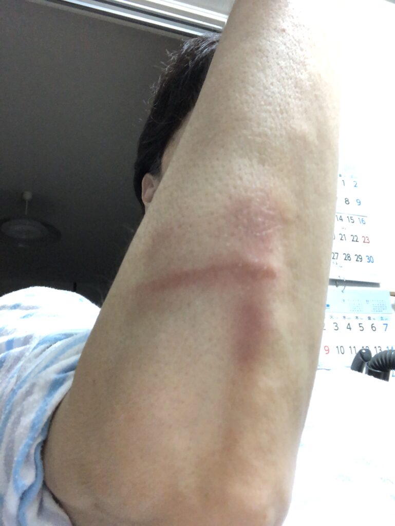 スイカを救ったキズ